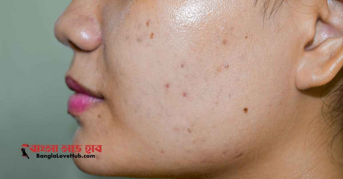 তৈলাক্ত ত্বকের ব্রণ দূর করার ঘরোয়া উপায়