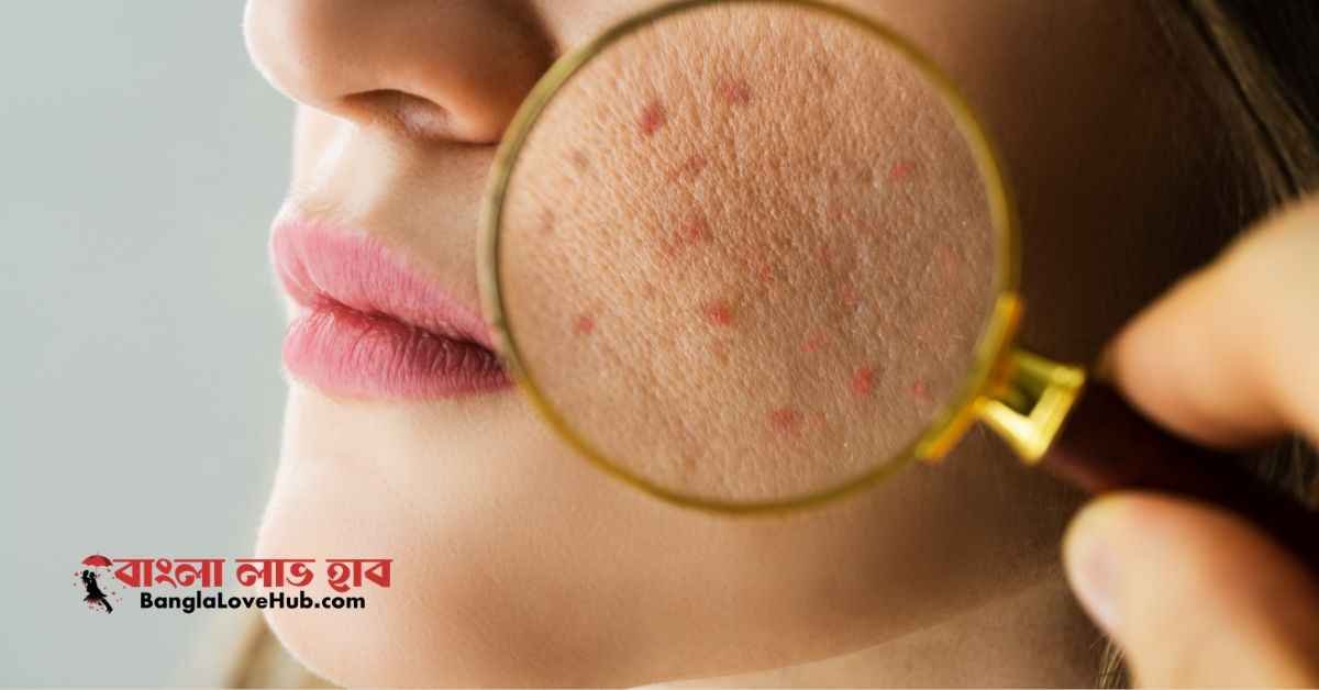 ব্রণের জন্য কোন ফেসওয়াস ভালো