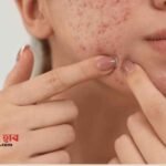 মুখে ব্রণ হলে কি মাখা উচিত