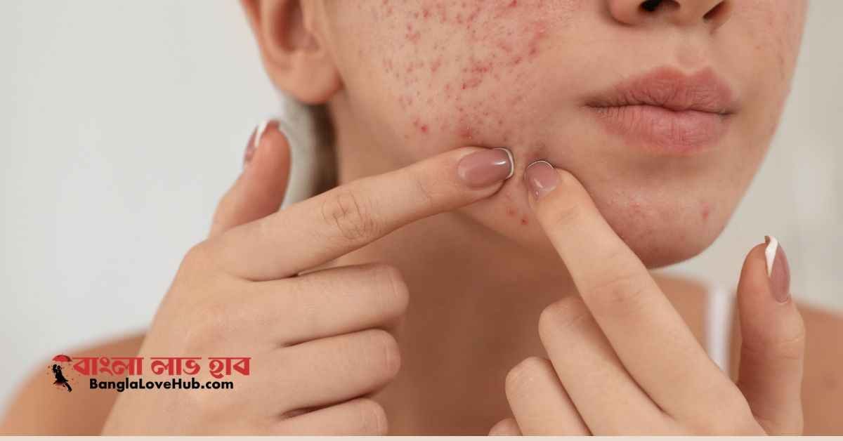 মুখে ব্রণ হলে কি মাখা উচিত