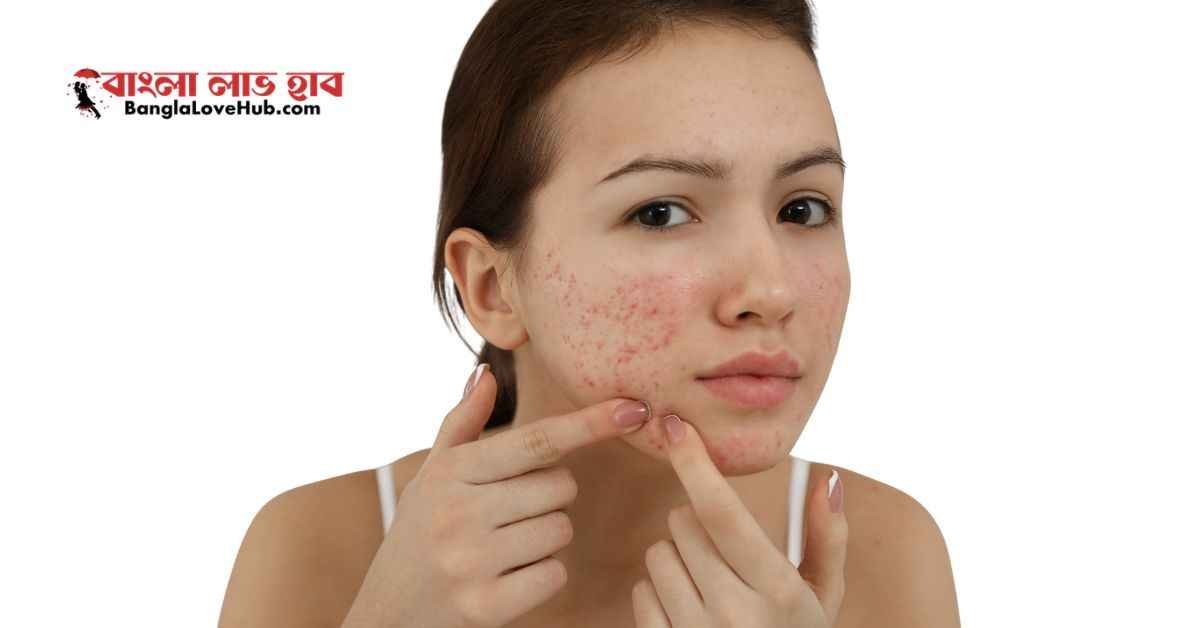 ১ দিনে ব্রণের দাগ দূর করার উপায়